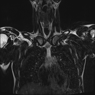Bilateral spinoglenoid notch ganglion cysts (Radiopaedia 29577-30082 Coronal T2 36).jpg