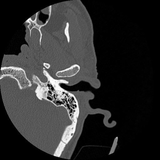 Bilateral temporal bone fractures (Radiopaedia 29482-29970 D 45).jpg