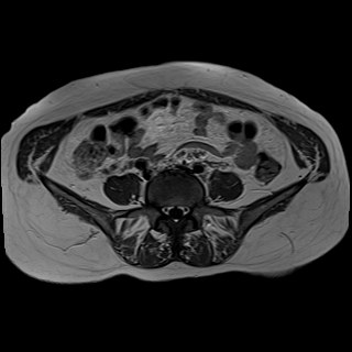 Bilateral tubo-ovarian abscesses (Radiopaedia 58635-65829 Axial T1 C+ 1).jpg