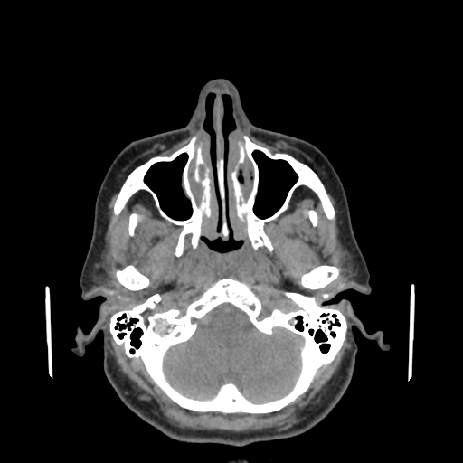 Bisphosphonate-related osteonecrosis of the jaw (Radiopaedia 71324-81642 non-contrast 140).jpg