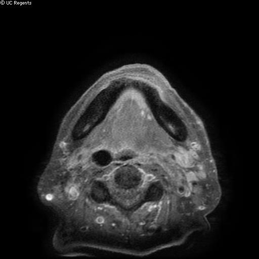 File:Bisphosphonate-related osteonecrosis of the maxilla (Radiopaedia 51367-57101 Axial T1 C+ fat sat 3).jpg