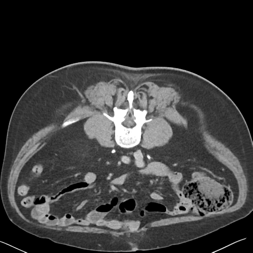File:Bladder papillary urothelial carcinoma (Radiopaedia 48119-52951 Axial C+ delayed 30).png