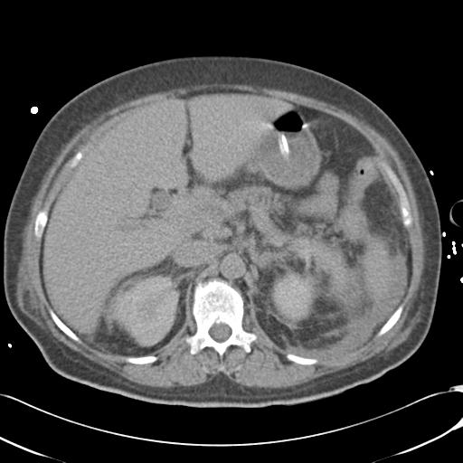 File:Bladder rupture post renal biopsy (Radiopaedia 30863-31572 Axial non-contrast 29).jpg
