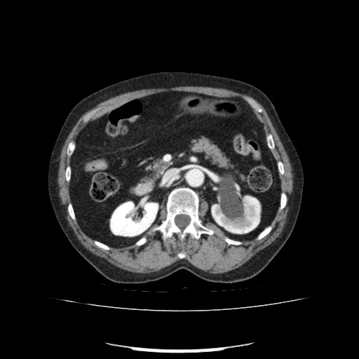File:Bladder tumor detected on trauma CT (Radiopaedia 51809-57609 B 51).jpg