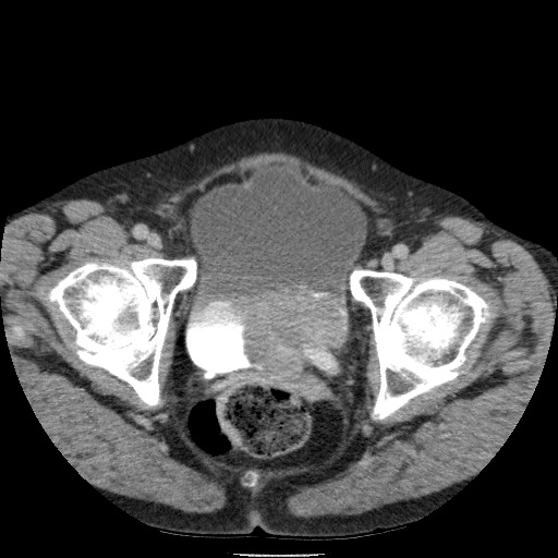 Bladder tumor detected on trauma CT (Radiopaedia 51809-57609 C 132).jpg
