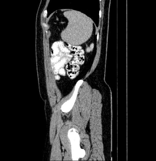 Blind-ending branch of a bifid ureter (Radiopaedia 61159-69048 E 75).jpg