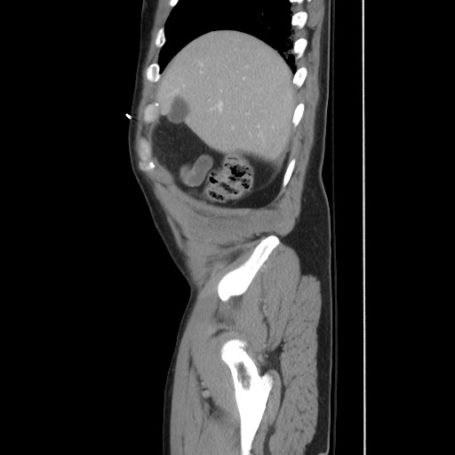 File:Blunt abdominal trauma with solid organ and musculoskelatal injury with active extravasation (Radiopaedia 68364-77895 C 34).jpg