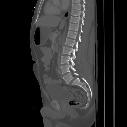 Blunt abdominal trauma with solid organ and musculoskelatal injury with active extravasation (Radiopaedia 68364-77895 Sagittal bone window 49).jpg