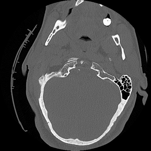 File:Blunt cerebrovascular injury (Radiopaedia 53682-59743 Axial bone window 12).png