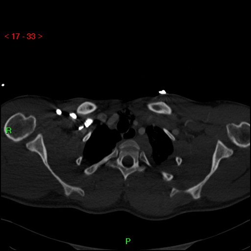 Blunt thoracic trauma (Radiopaedia 73454-84221 Axial bone window 13).jpg