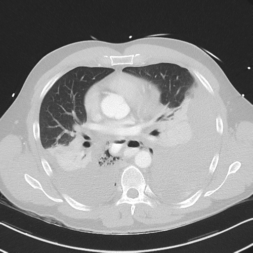 Boerhaave syndrome (Radiopaedia 39382-41661 Axial lung window 29).png