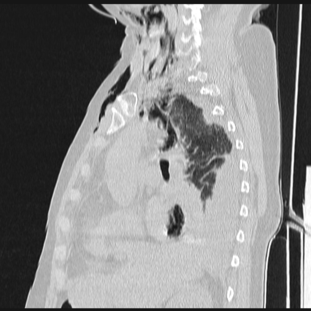 Boerhaave syndrome (Radiopaedia 45644-49799 Sagittal lung window 32).jpg