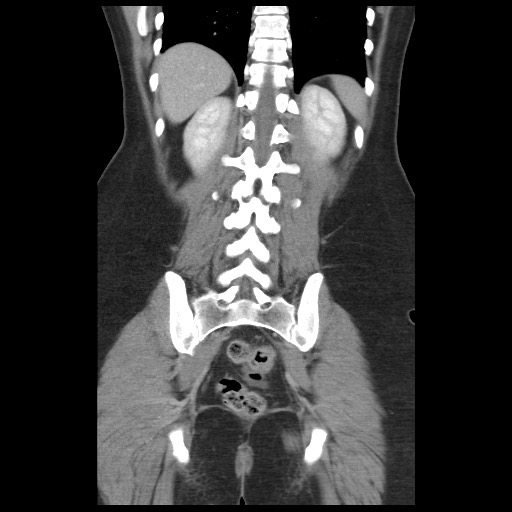 Borderline mucinous tumor (ovary) (Radiopaedia 78228-90808 C 39).jpg