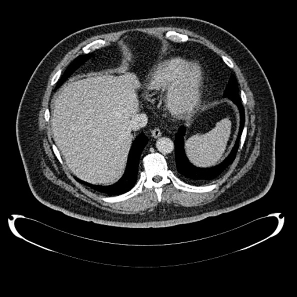 Bosniak renal cyst - type IV (Radiopaedia 24244-24518 C 23).jpg