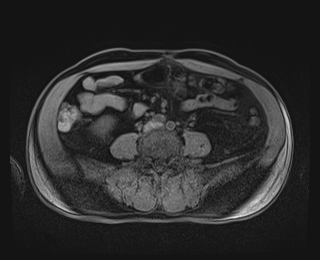 Bouveret syndrome (Radiopaedia 61017-68856 Axial T1 fat sat 63).jpg