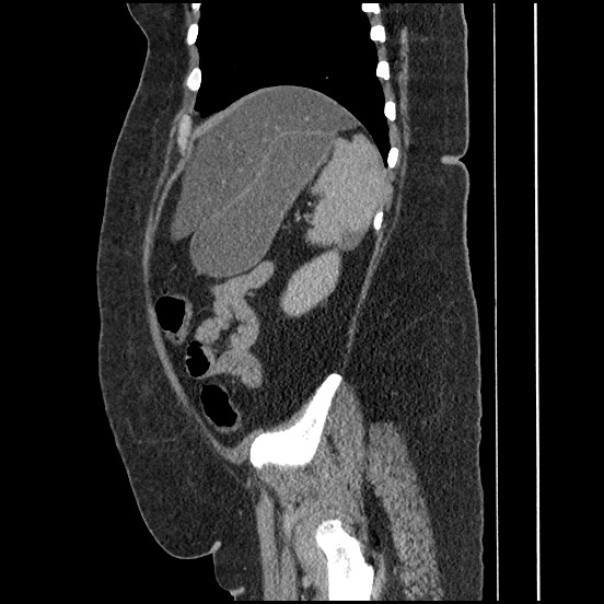 Bowel and splenic infarcts in acute lymphocytic leukemia (Radiopaedia 61055-68913 C 24).jpg