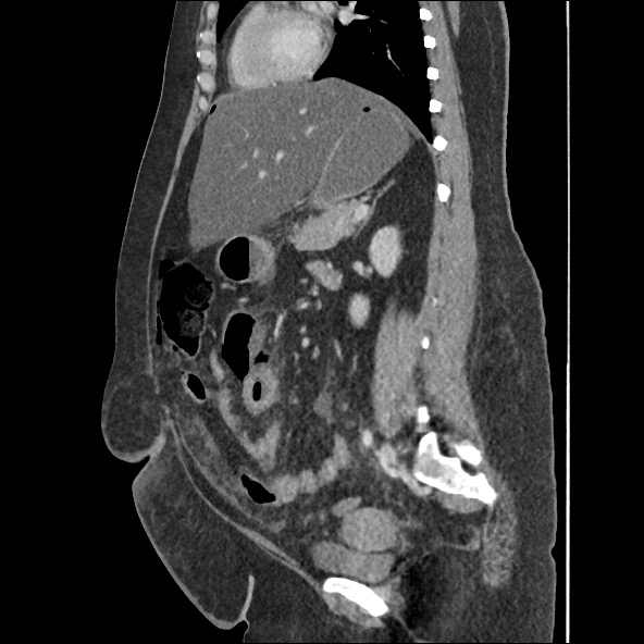 Bowel and splenic infarcts in acute lymphocytic leukemia (Radiopaedia 61055-68915 C 30).jpg
