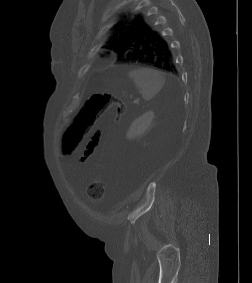 Bowel ischemia secondary to SMA occlusion with extensive portomesenteric venous gas (Radiopaedia 54656-60871 Sagittal bone window 18).jpg