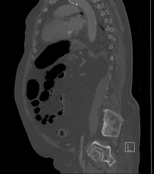 Bowel ischemia secondary to SMA occlusion with extensive portomesenteric venous gas (Radiopaedia 54656-60871 Sagittal bone window 39).jpg