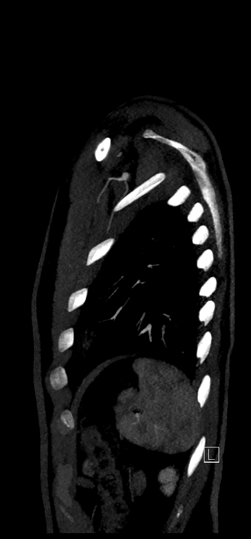 Brachiocephalic trunk pseudoaneurysm (Radiopaedia 70978-81191 C 80).jpg