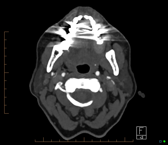 Brachiocephalic trunk stenosis (Radiopaedia 87242-103519 A 74).jpg