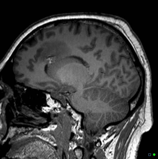 Brain death on MRI and CT angiography (Radiopaedia 42560-45689 Sagittal T1 12).jpg