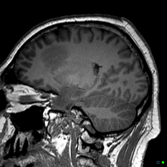 Brain death on MRI and CT angiography (Radiopaedia 42560-45689 Sagittal T1 5).jpg