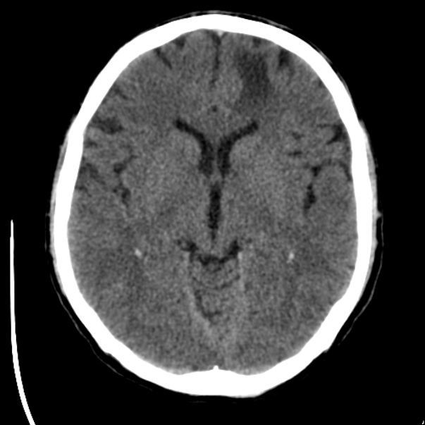 Brain metastases from lung cancer (Radiopaedia 24480-24781 Axial non-contrast 22).jpg