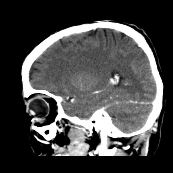 Brain metastases from lung cancer (Radiopaedia 24480-24781 C+ delayed 19).jpg