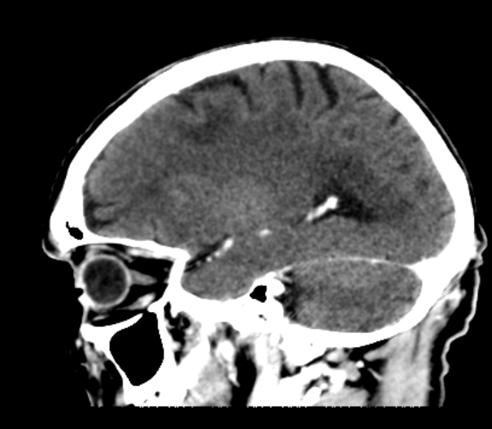 Brain metastases from lung cancer (Radiopaedia 27849-28092 Sagittal C+ delayed 42).jpg