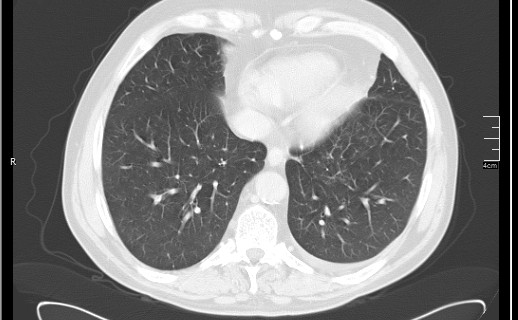 Brain metastases from squamocellular lung cancer (Radiopaedia 56515-63219 Axial lung window 48).jpg