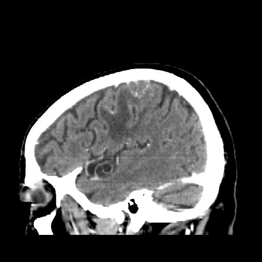 Brain metastasis (Radiopaedia 42617-45760 D 45).jpg