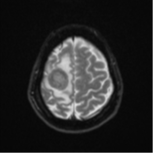Brain metastasis (sarcoma) (Radiopaedia 47576-52209 Axial DWI 22).png