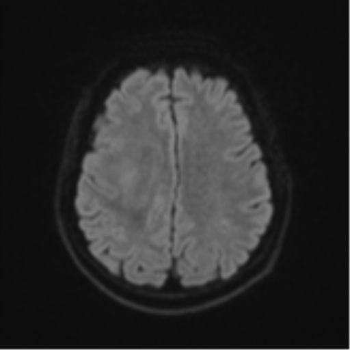 Brain metastasis (sarcoma) (Radiopaedia 47576-52209 Axial DWI 46).png