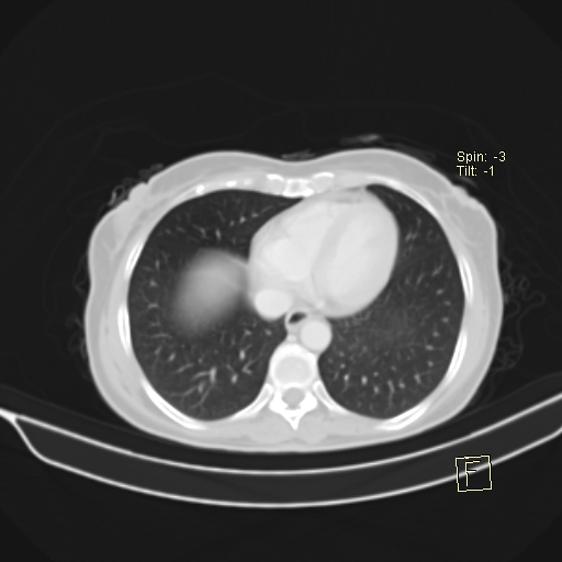 File:Brain metastasis as initial presentation of non-small cell lung cancer (Radiopaedia 65122-74127 Axial lung window 34).jpg