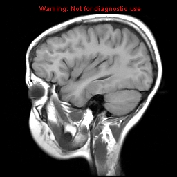 File:Brainstem glioma (Radiopaedia 9444-10124 Sagittal T1 11).jpg