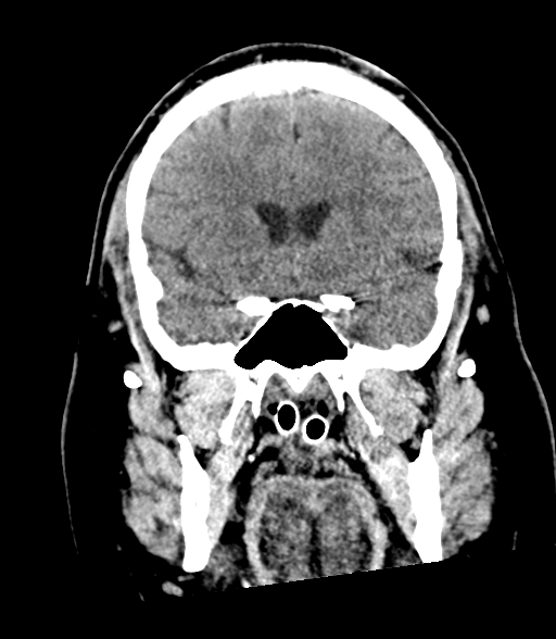Brainstem hemorrhage (Radiopaedia 81294-94976 Coronal non-contrast 25).jpg