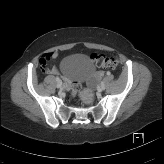 File:Breast metastases from renal cell cancer (Radiopaedia 79220-92225 C 90).jpg