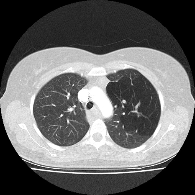 Bronchial atresia (Radiopaedia 22965-22992 Axial lung window 36).jpg