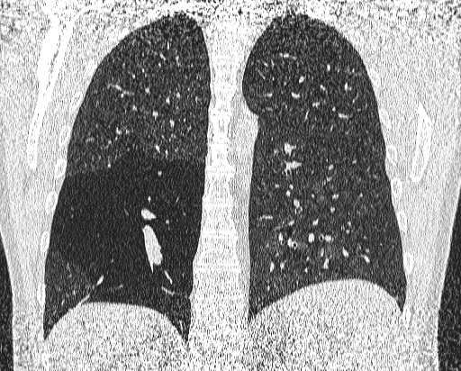 Bronchial atresia (Radiopaedia 58271-65417 Coronal lung window 41).jpg
