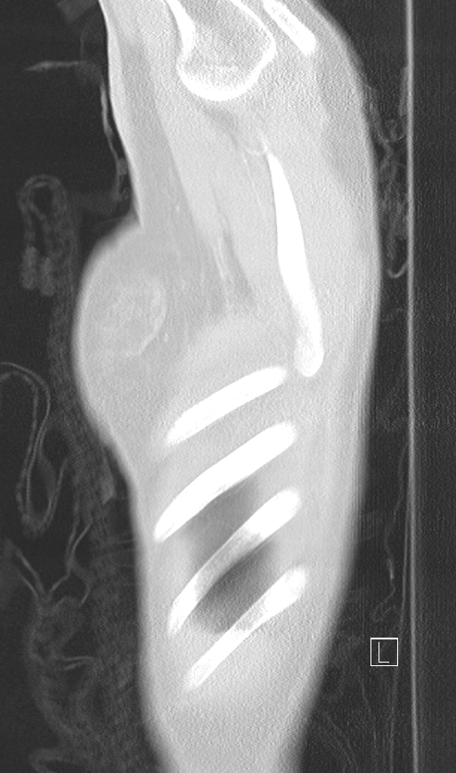 Bronchial atresia (Radiopaedia 73677-84470 Sagittal lung window 2).jpg