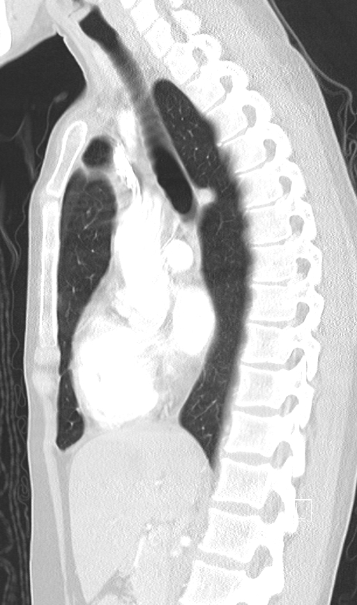 Bronchial atresia (Radiopaedia 73677-84470 Sagittal lung window 26).jpg