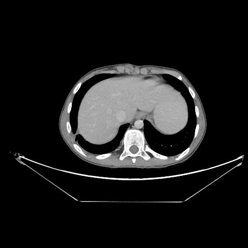 File:Bronchial carcinoid tumor (Radiopaedia 57187-64090 A 65).jpg