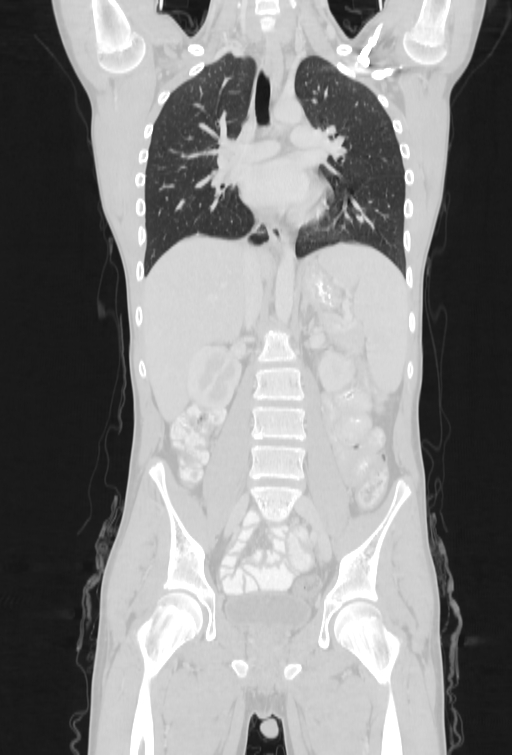 Bronchial carcinoid tumor (Radiopaedia 57187-64090 Coronal lung window 50).jpg