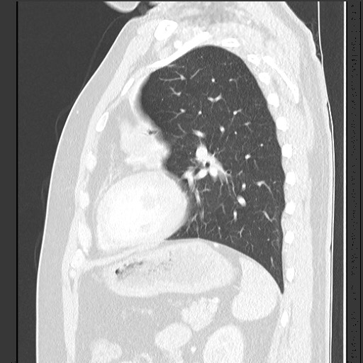 Bronchial carcinoid tumor (Radiopaedia 67377-76764 Sagittal lung window 49).jpg