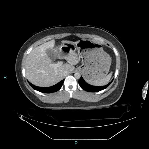 Bronchial carcinoid tumor (Radiopaedia 78272-90870 C 113).jpg