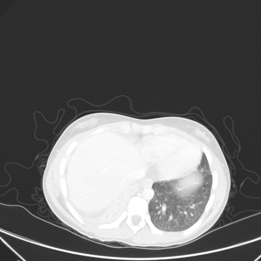 Bronchial mucoepidermoid carcinoma (Radiopaedia 57023-63895 Axial lung window 88).jpg