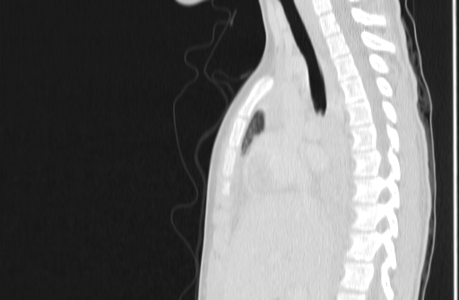 Bronchial mucoepidermoid carcinoma (Radiopaedia 57023-63895 Sagittal lung window 69).jpg