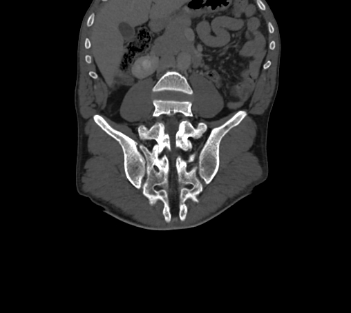 Bronchiectasis in Crohn disease (Radiopaedia 60311-67977 Coronal bone window 46).jpg