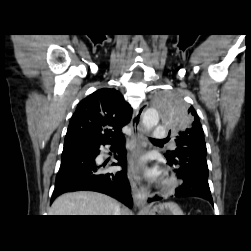 Bronchogenic carcinoma (Radiopaedia 73497-84262 C 76).jpg